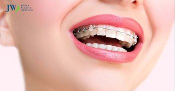 Ưu và nhược điểm của niềng răng mắc cài sứ ít người biết