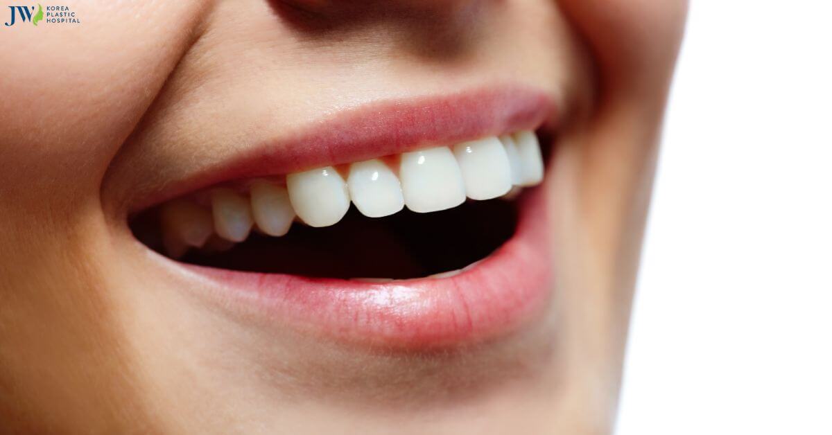 Bọc sứ toàn hàm có mấy loại và chi phí như thế nào? thumb