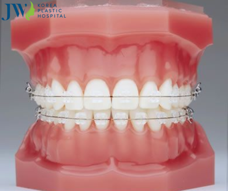 Quá trình niềng răng ảnh hưởng đến phát âm hay không?