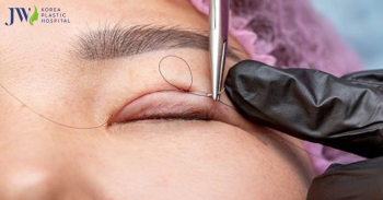 Cắt mắt hai mí và 5 điều bạn có thể chưa biết