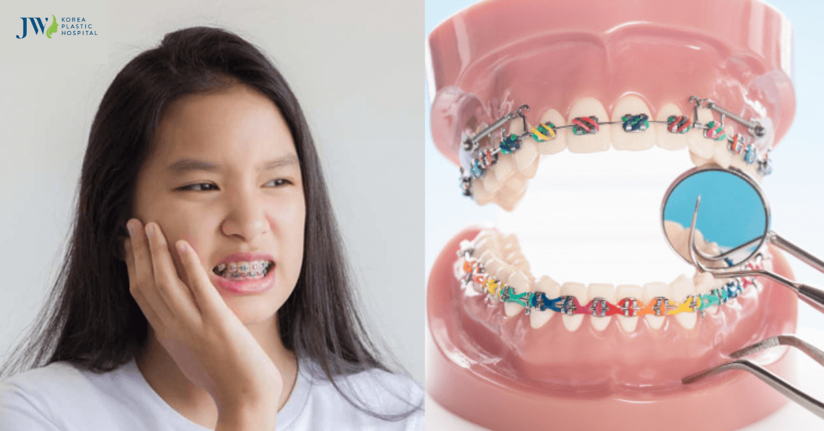 dấu hiệu khi mới niềng răng