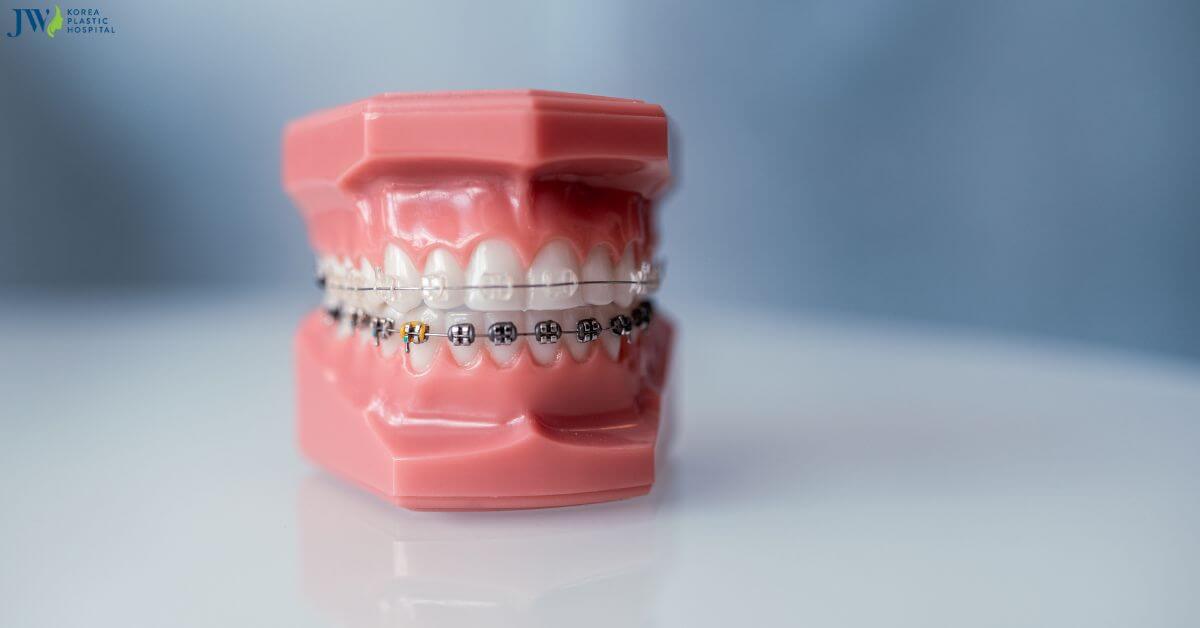 Giải đáp: Niềng răng có cần phẫu thuật không? thumb