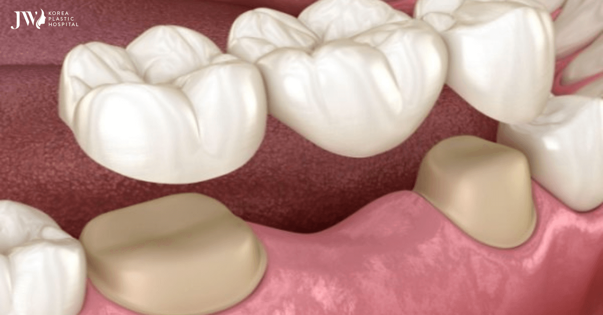 làm cầu răng sứ niềng răng