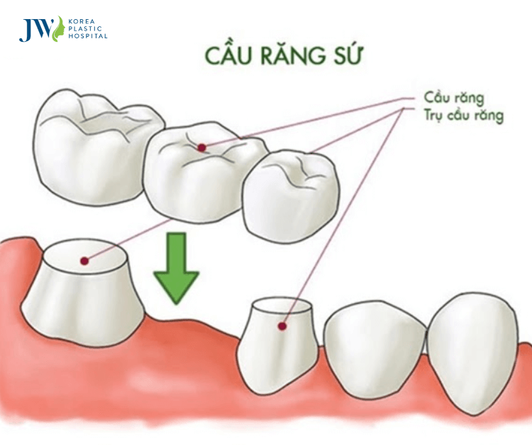 làm cầu răng sứ niềng răng