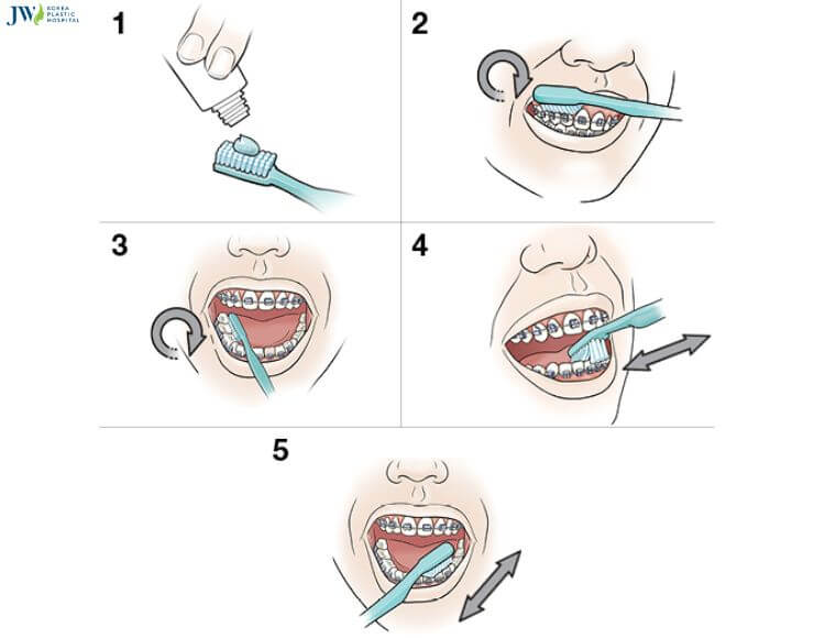 Mách bạn 7 bí quyết vệ sinh răng miệng khi niềng chuẩn nha khoa 2