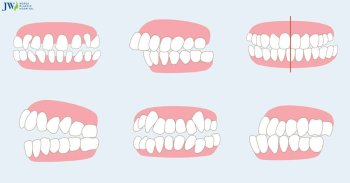 Niềng răng có điều trị lệch khớp cắn không?