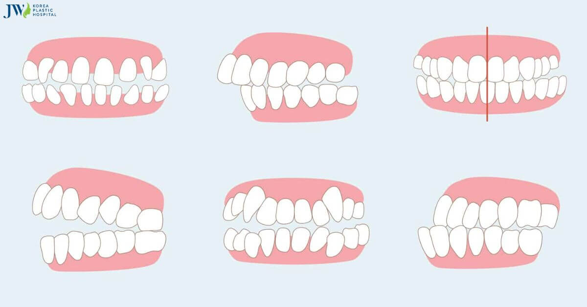 Niềng răng trị lệch khớp cắn