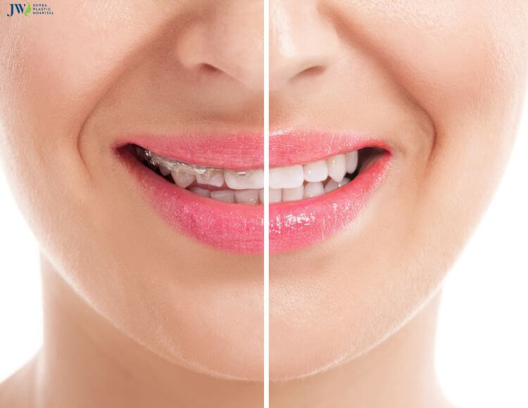 Niềng răng giúp mũi cao hơn đúng hay sai? 2