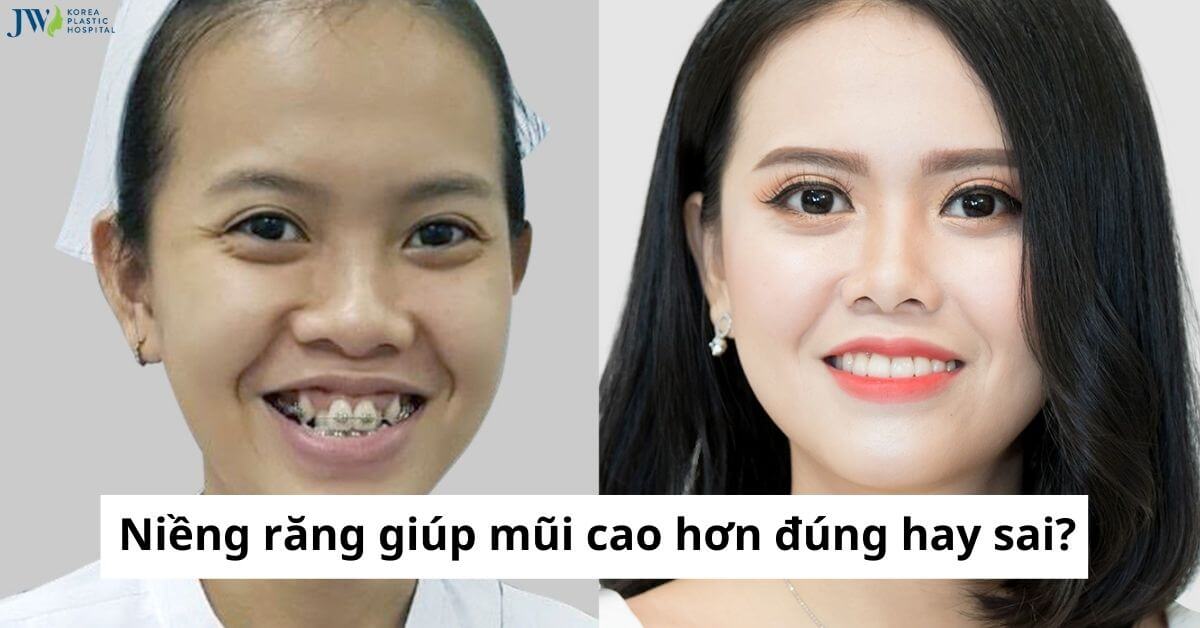 Niềng răng giúp mũi cao hơn đúng hay sai? thumb