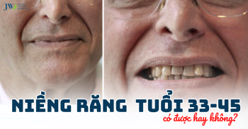 Niềng Răng Ở Độ Tuổi 33-45 Có Nên Hay Không?
