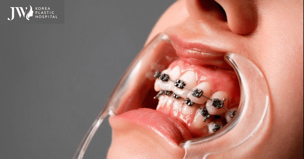 niềng răng sau 6 tháng