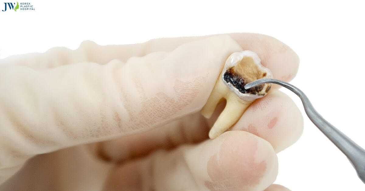 Sâu răng có niềng răng được không? thumb