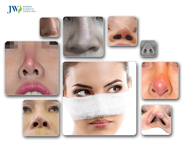 Tái phẫu thuật mũi - Giải pháp khắc phục mọi dáng mũi biến chứng