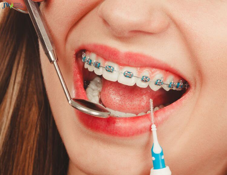 Tại sao niềng răng lại gây ê buốc răng? Cách điều trị tại nhà? 1
