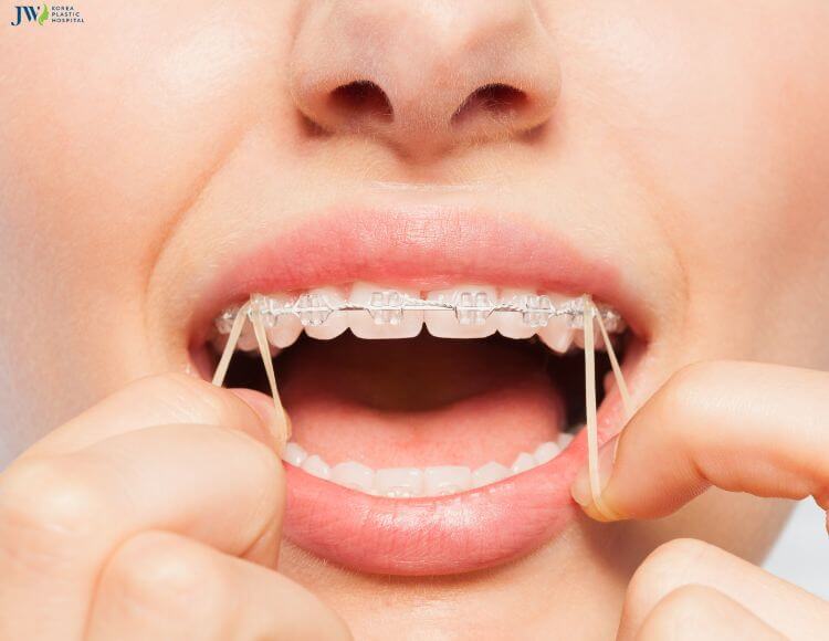 Tất tần tật về các loại thun phổ biến nhất trong niềng răng! 3