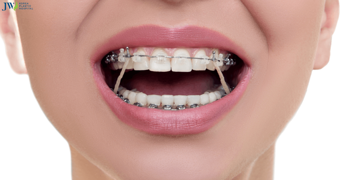 Thun liên hàm - Vì sao là nỗi "ám ảnh" của các đồng niềng!