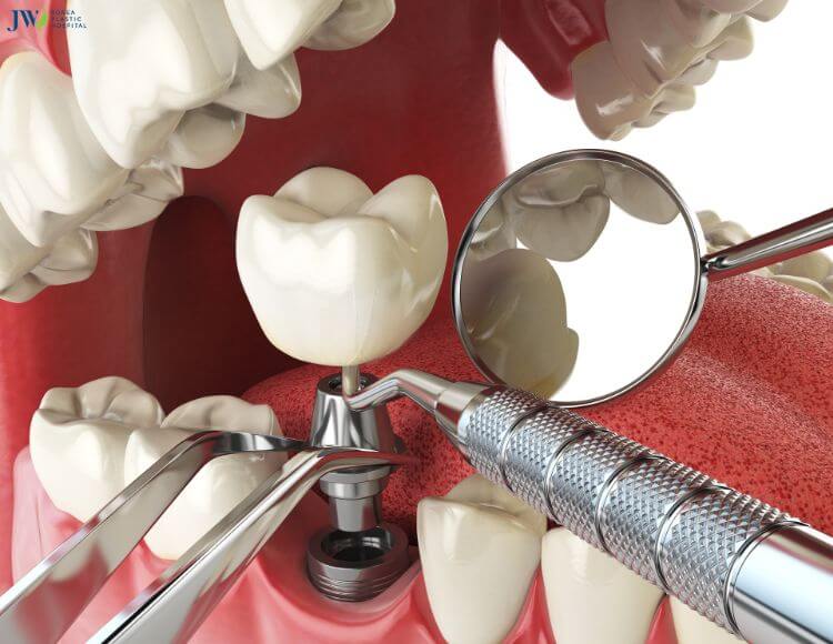 Trồng răng Implant: Khái niệm, đối tượng, chi phí 1