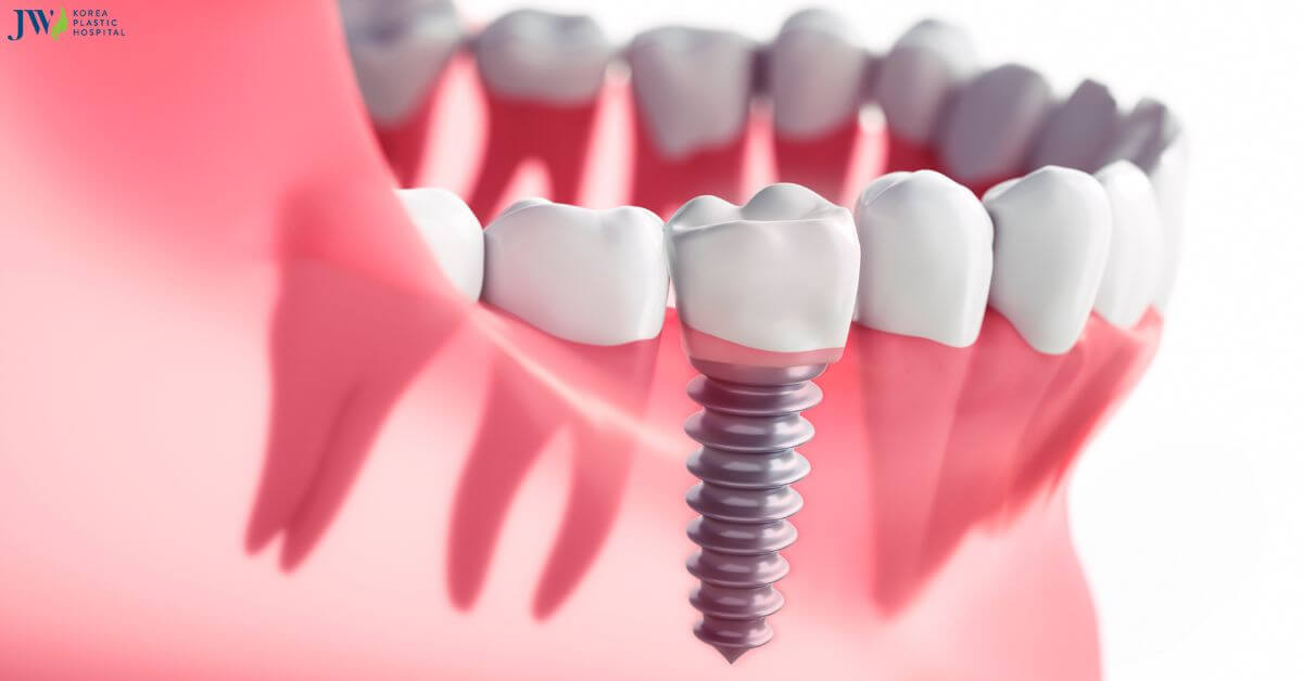 Trồng răng Implant: Khái niệm, đối tượng, chi phí thumb