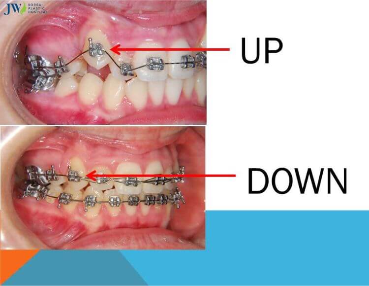 niềng răng thay đổi vị trí răng