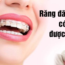 Răng đã bọc sứ có niềng được không?