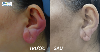 Biến chứng sau tiêm silicon tạo ‘tai Phật’, tay búp măng