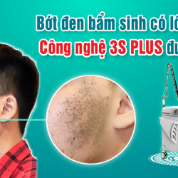 Bớt đen bẩm sinh có lông điều trị Công nghệ 3S PLUS được không?