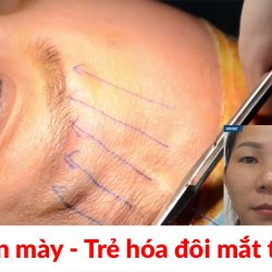 Treo chân mày: Trẻ hóa đôi mắt toàn diện chỉ với 45 phút 