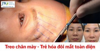 Treo chân mày: Trẻ hóa đôi mắt toàn diện chỉ với 45 phút