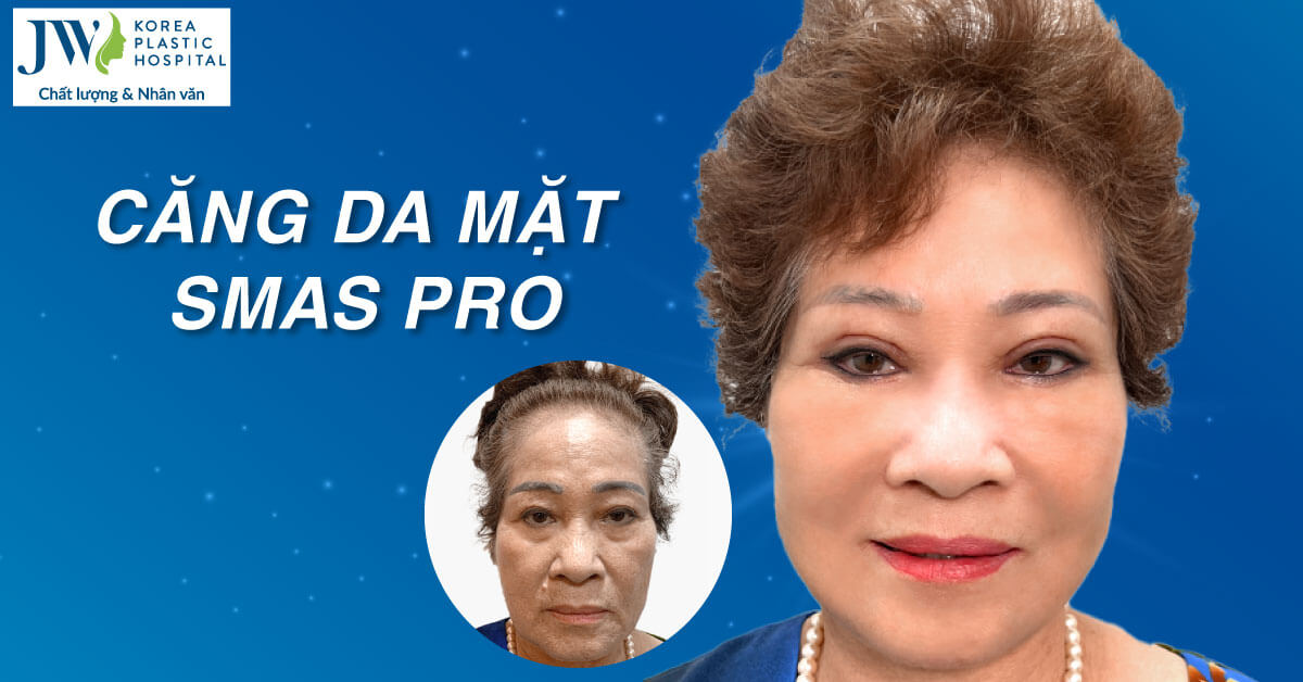 căng da mặt smas pro