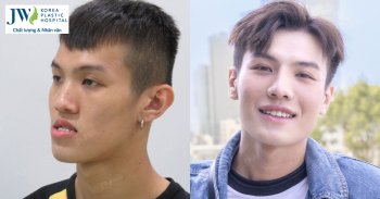 Phẫu thuật hàm móm giúp 1 nam sinh bước chân vào showbiz