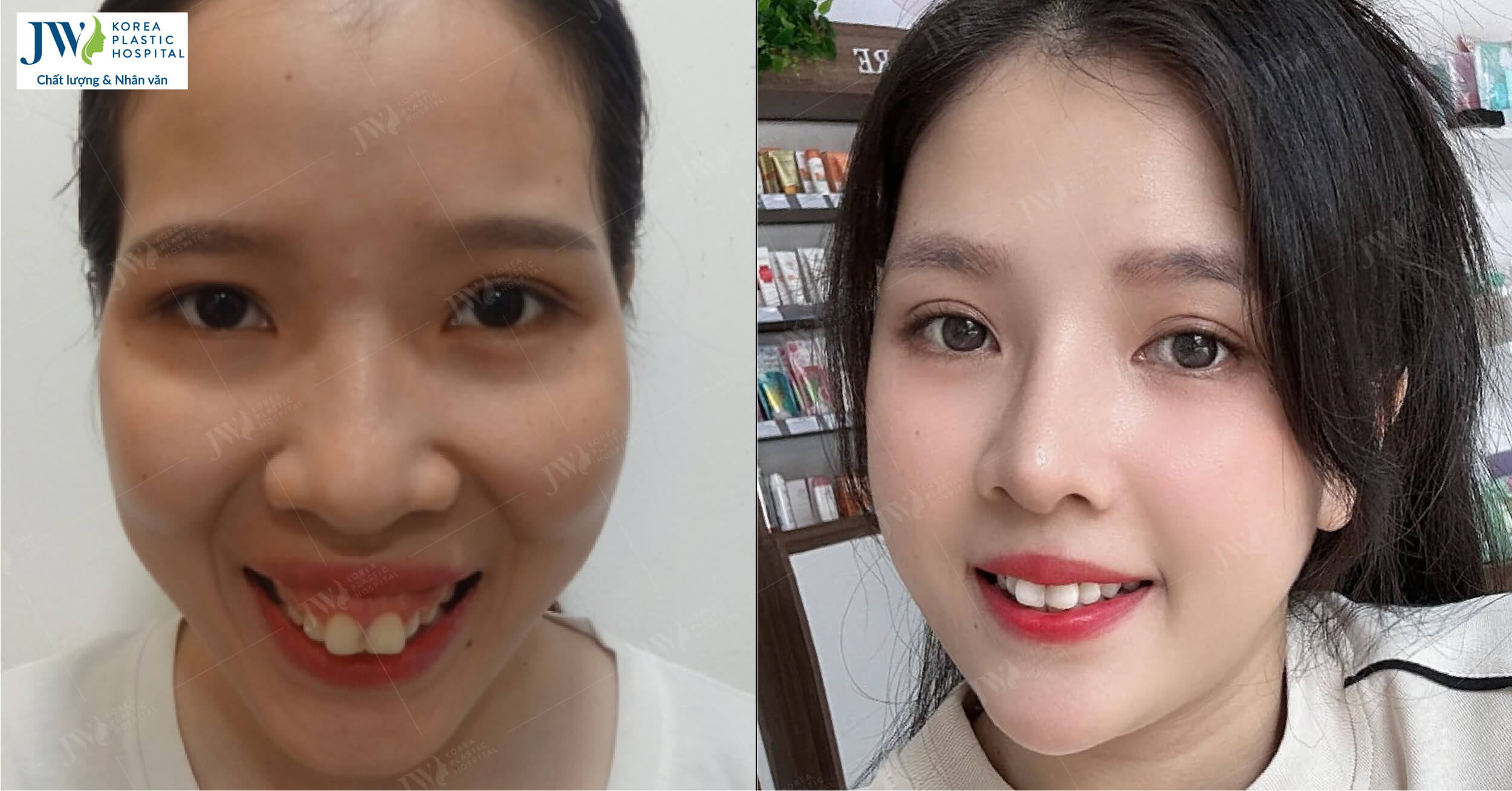 phẫu thuật hàm hô