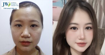 Cô gái gây sốt cộng đồng mạng sau Phẫu thuật thẩm mỹ