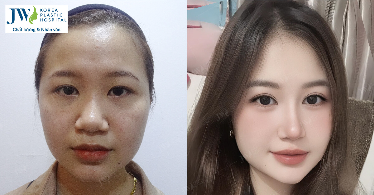 nâng mũi thiên kim