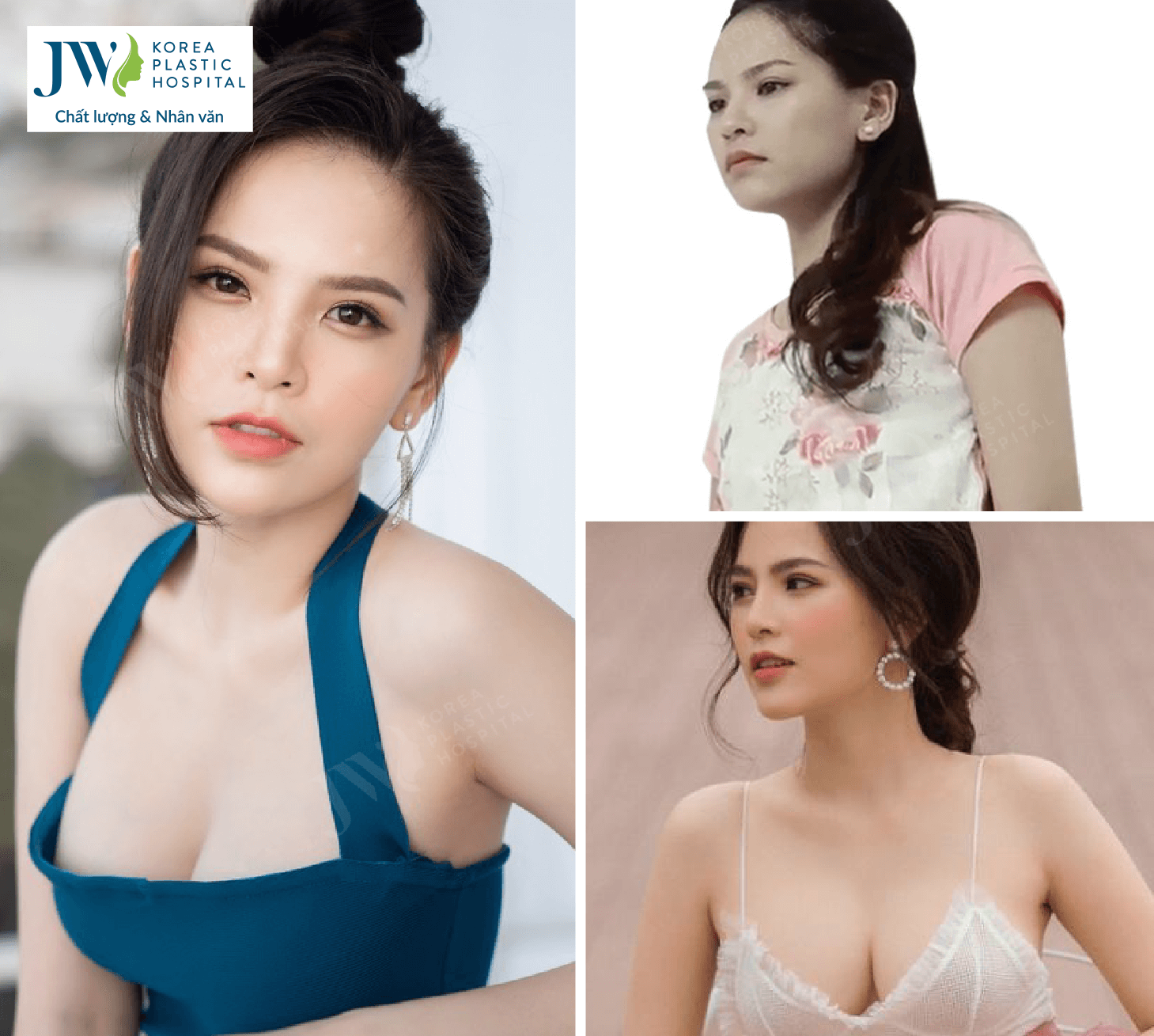 nang-nguc-va-hut-mo-bung