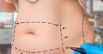 doi-tuong-khong-duoc-hut-mo-bung