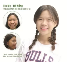 Kinh nghiệm phẫu thuật hàm hô – Chia sẻ từ người trong cuộc từng thẩm mỹ hàm hô và đã thành công
