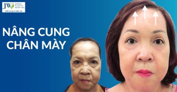 nâng cung chân mày