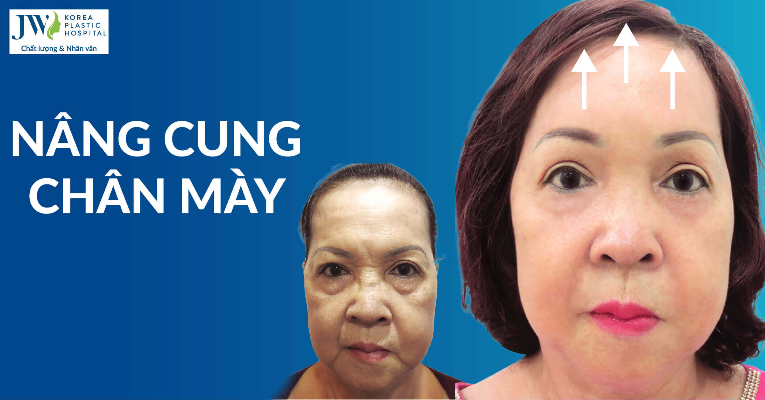 nâng cung chân mày