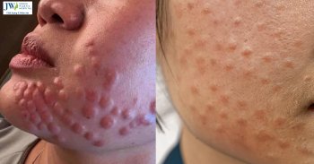 Tiêm meso trẻ hóa da: Dấu hiệu nhận biết tai biến sau khi thực hiện thế nào?