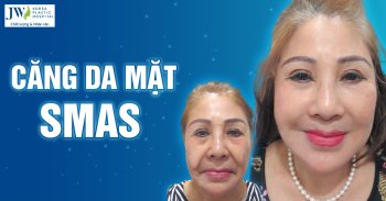 căng da mặt Smas