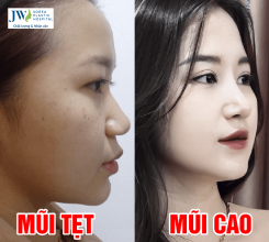 Nâng Mũi S Line – Xu Hướng Nâng Mũi Mới Nhất
