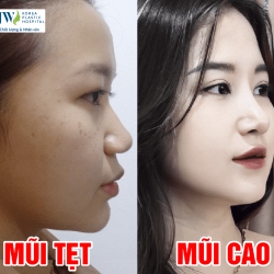 Nâng Mũi S Line – Xu Hướng Nâng Mũi Mới Nhất