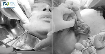 tai biến phẫu thuật thẩm mỹ