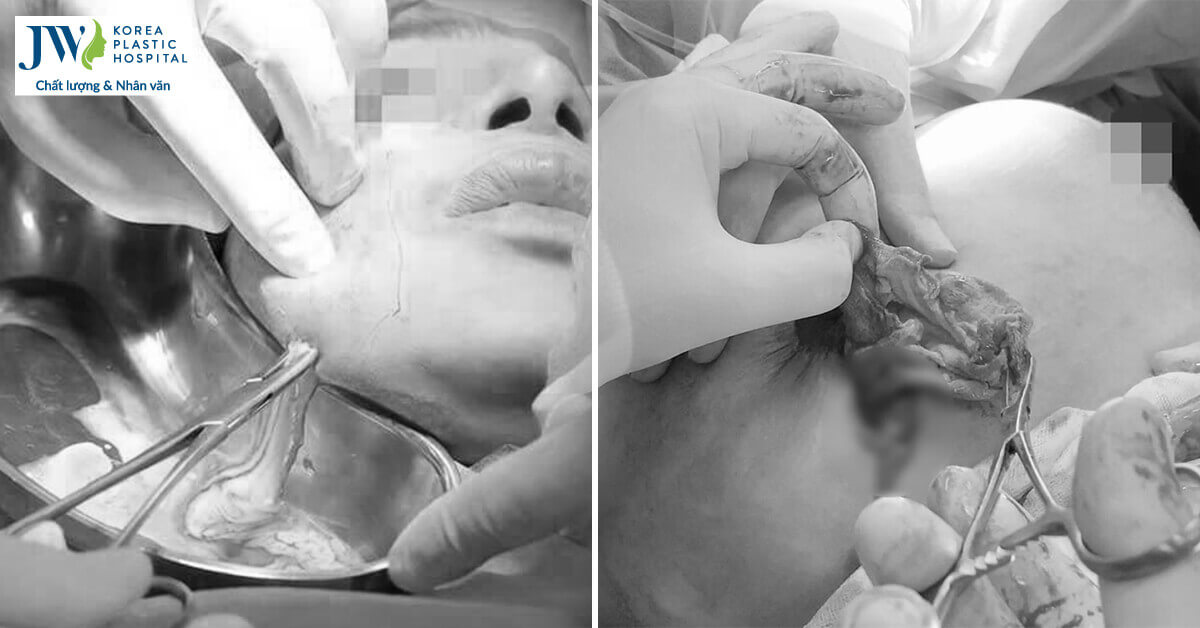 tai biến phẫu thuật thẩm mỹ