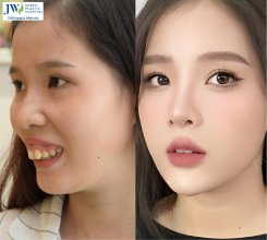 Phẫu thuật hàm hô có để lại di chứng không? – Bệnh viện JW