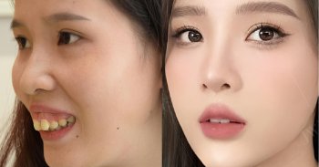 truoc-va-sau-khi-phau-thuat-ham-ho