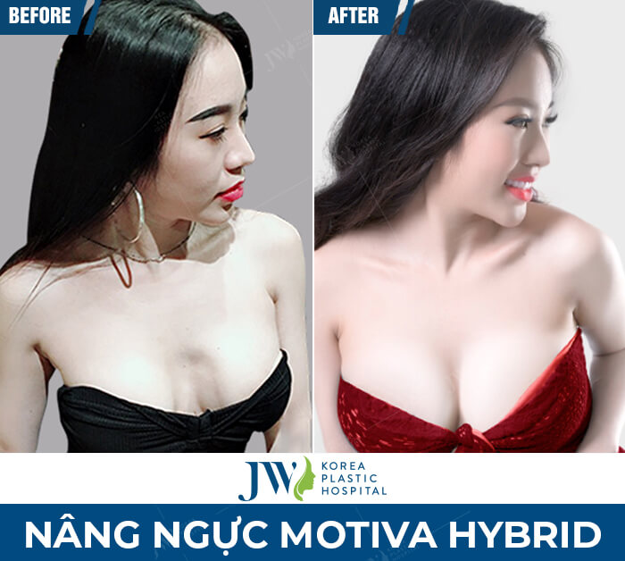 nang-nguc-motiva-hybrid