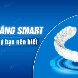 Niềng răng SMART và những điều bạn cần biết trước khi thực hiện