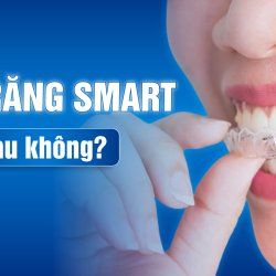 Niềng răng SMART có đau không? Quy trình niềng răng ra sao?