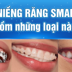 Niềng răng SMART bao gồm những loại nào? Loại nào tốt nhất